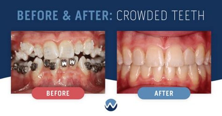 Are my teeth overcrowded?