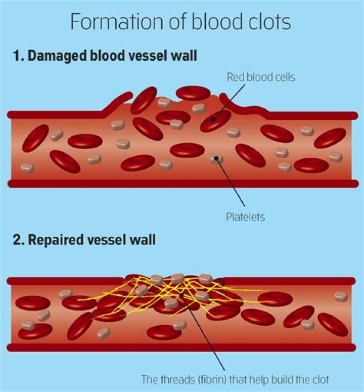 Can blood clots move while on blood thinners?