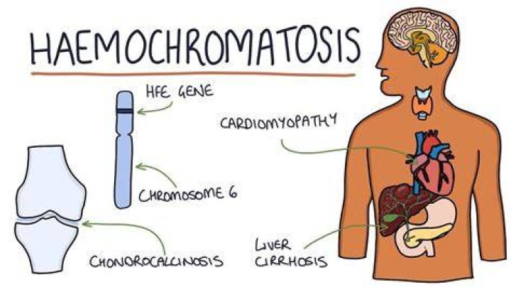 Can haemochromatosis affect eyesight?