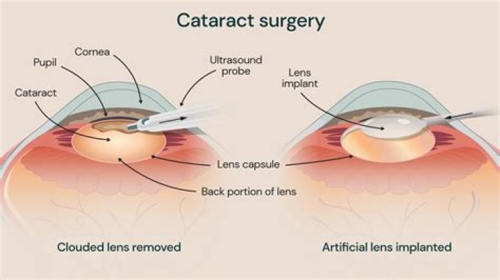 Can I eat egg after cataract surgery?