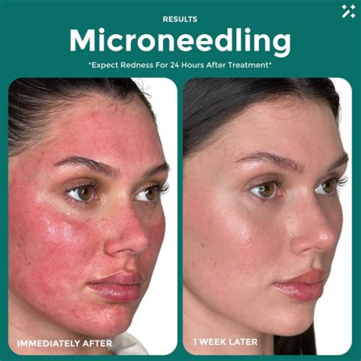 Can microneedling cause lumps?