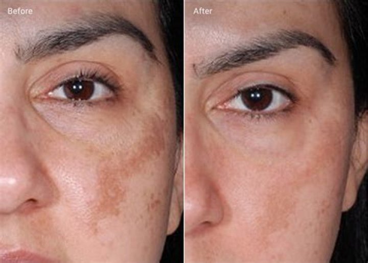 Can microneedling make hyperpigmentation worse?