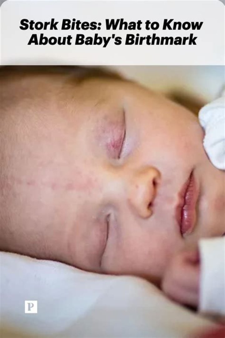 Can stork bites show up after birth?