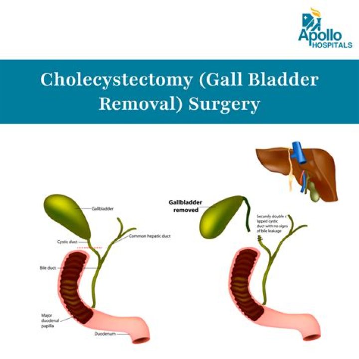 Can you avoid gallbladder surgery?
