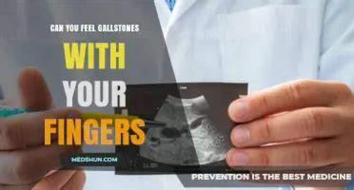 Can you feel gallstones with your fingers?