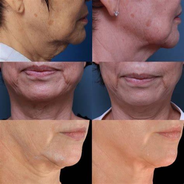 Can you microneedle your double chin?