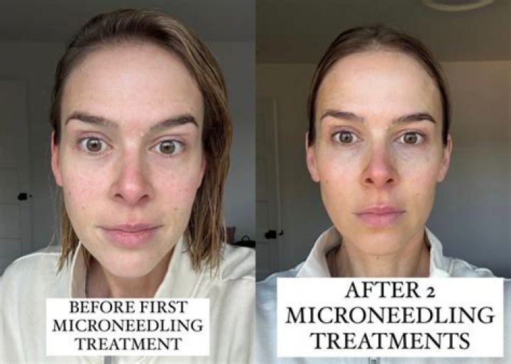 Do scars get worse before better with microneedling?