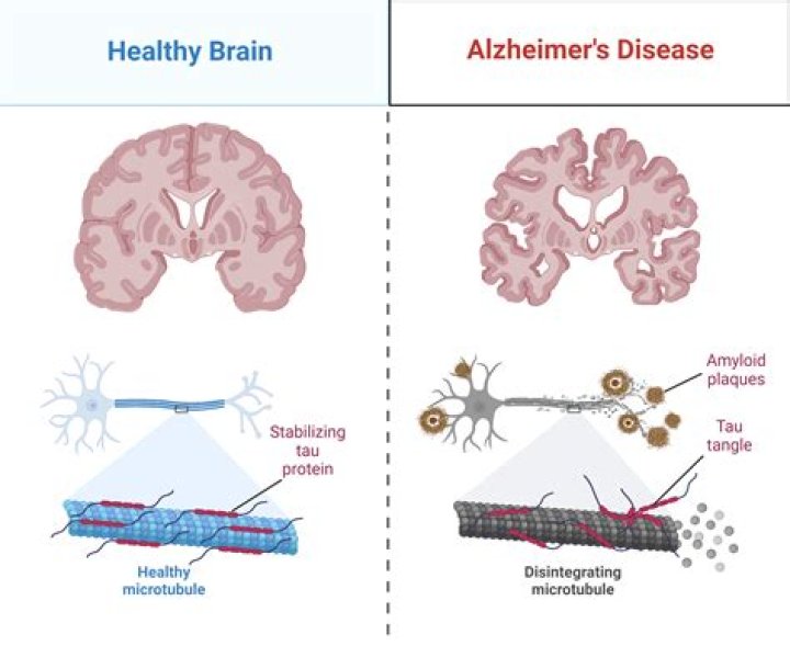Does Ativan cause Alzheimer's?