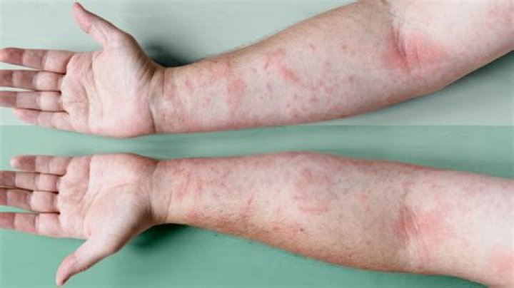 Does ibuprofen help eczema?