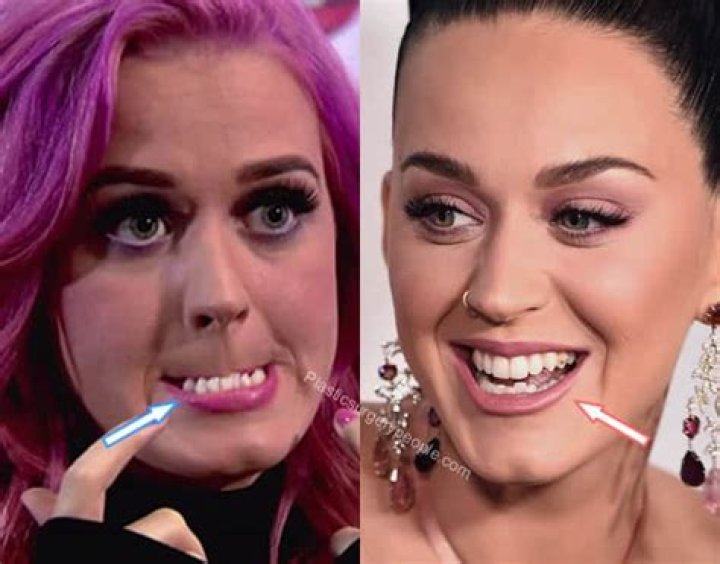Does Katy Perry have crooked teeth?