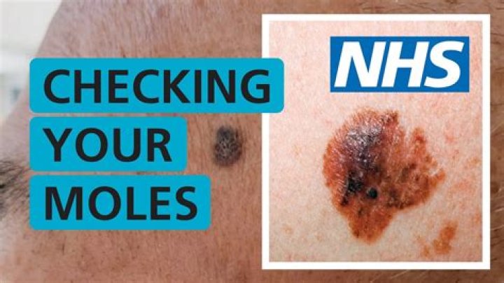 How can I tell if a mole is cancerous?