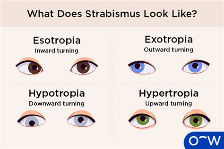 How do glasses treat strabismus?