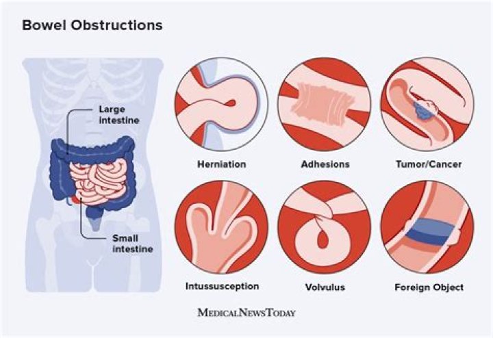 How do you clear a cat's bowel obstruction?