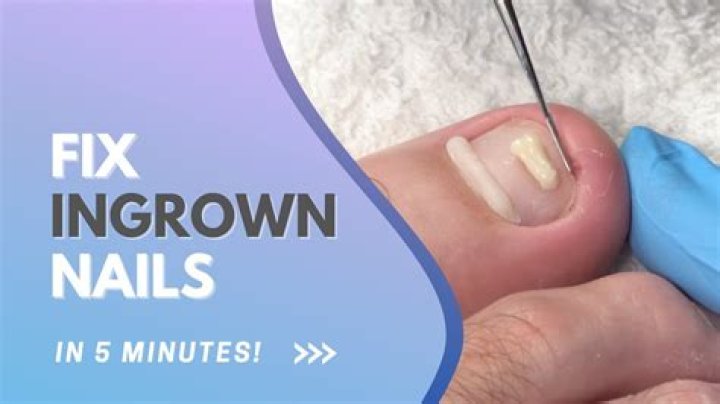 How do you fix ingrown toenails?