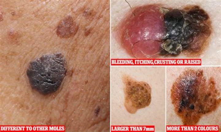 How do you know if moles are cancerous?