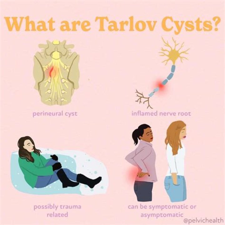 How do you know if you have a Tarlov cyst?