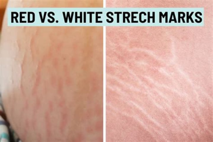 How long do stretch marks stay red?