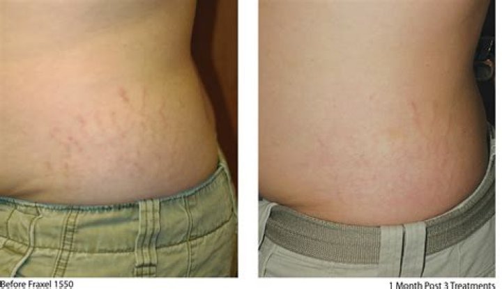How long does it take for stretch marks to fade?