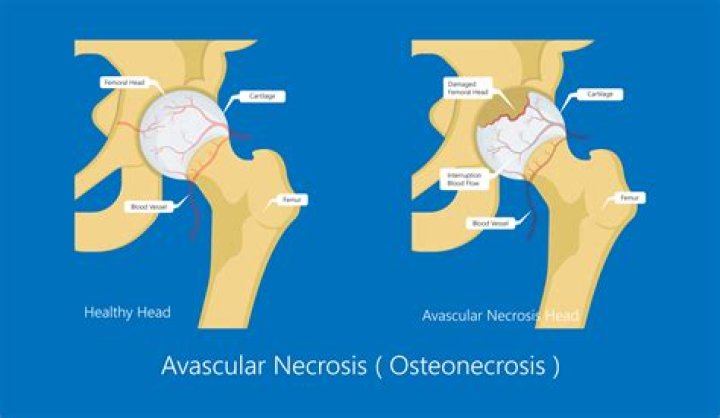 Is avascular necrosis reversible?