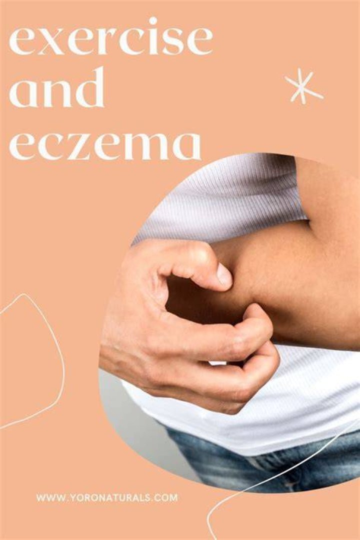 Is exercise good for eczema?