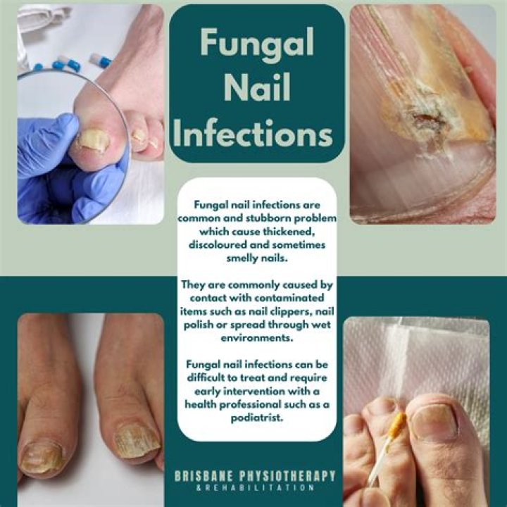 What causes fungus between toes?