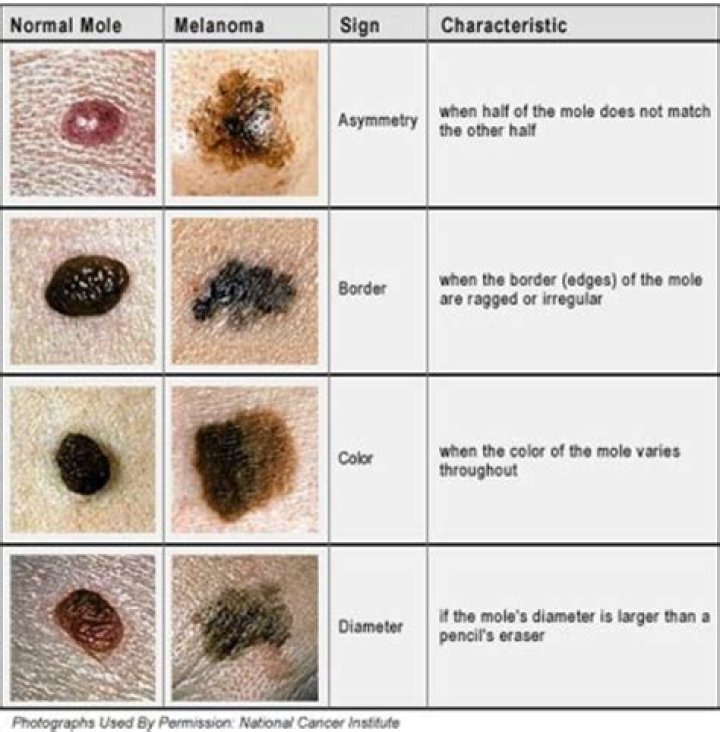 What do malignant moles look like?