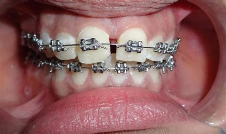 What is considered medically necessary for braces?