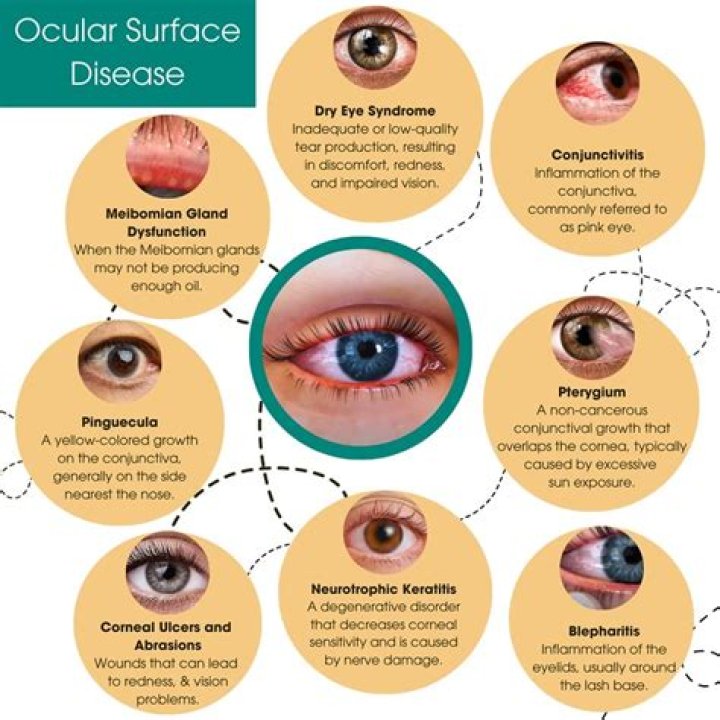What is ocular Marek's?