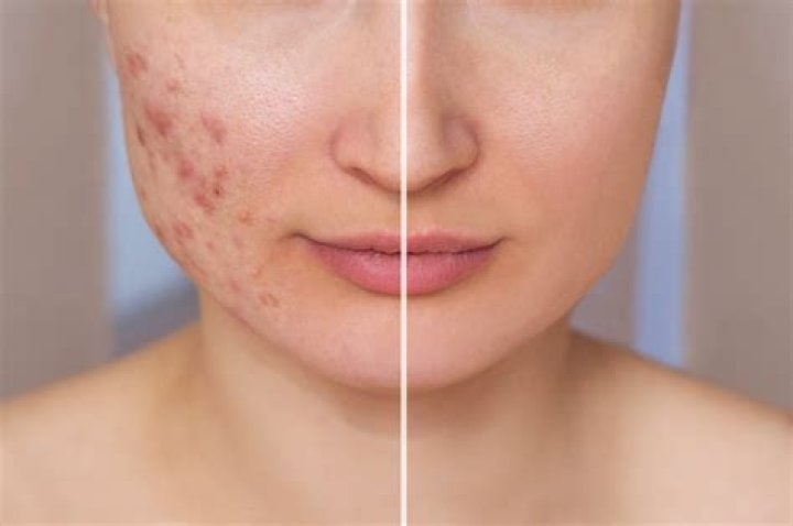 What race is prone acne?