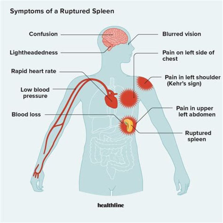 Where does spleen pain hurt?