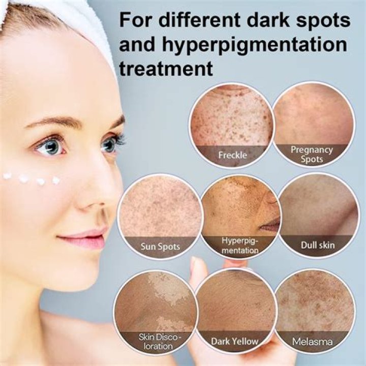 Which chemical is best for dark spots?