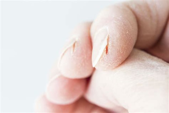Why do fingers crack near nails?