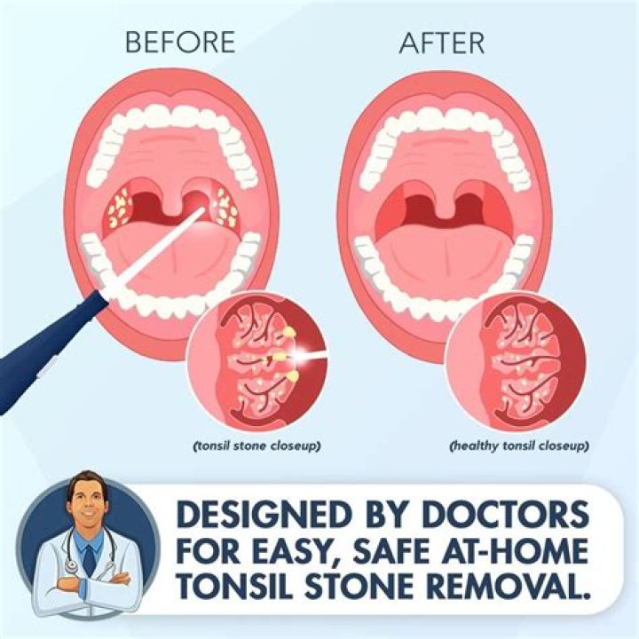 Why do I get tonsil stones even though I have good oral hygiene?