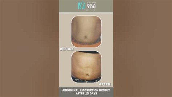 Why do I look pregnant after liposuction?