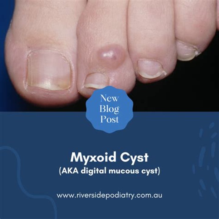 Why shouldn't you pop a digital mucous cyst?